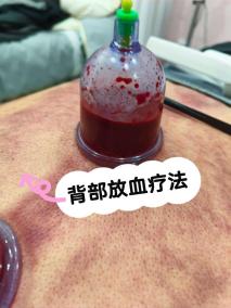 刺血疗法