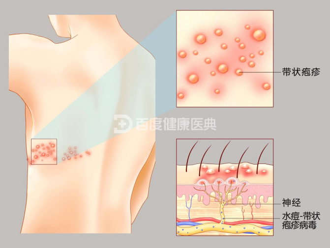 带状疱疹